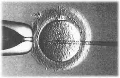 intracytoplasmic sperm injection